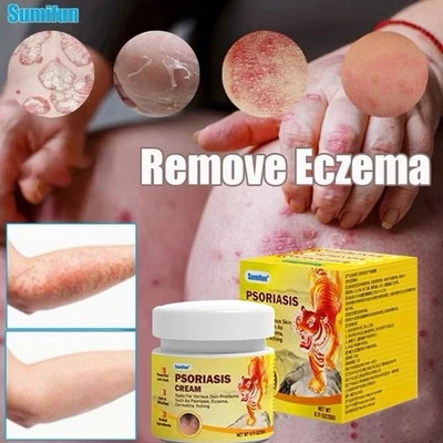 Psoriasis and eczyma cream - for itchy skin and skin hardening - Image 1 of 4