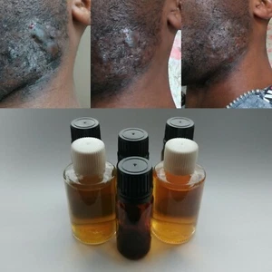 Powerful Keloid Scar Herbal Treatment (USA/Worldwide) x1 Bottle each - Picture 1 of 7