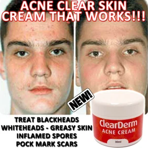 CLEARDERM ACNE CREAM WORKS FAST BEAUTIFUL FRESH CLEARSKIN - Picture 1 of 2