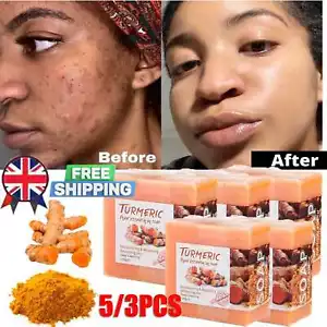 Tumeric Soap For Dark Spots, Skin Lightening, Anti Acne Skin Cleansing Soap Bar - Picture 1 of 32