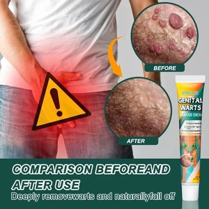 Genital Wart Removal Treatment Cream Wart & Tags Painlessly Remover Cream - Picture 1 of 7