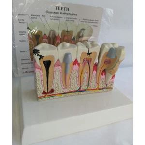 Dental Model Tooth Common Pathologies Anatomy Model Dental Model Medicine Teach - Picture 1 of 5