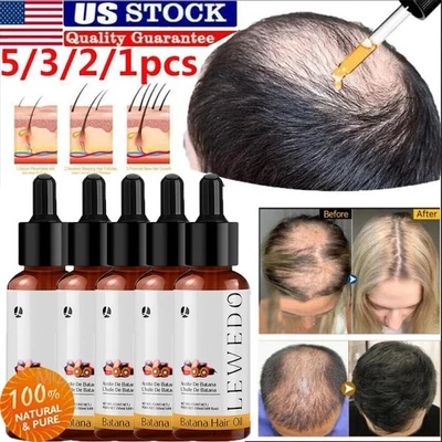 5/3Pcs Batana Oil Serum for Hair Growth, Batana Oil Organic, Repair Damaged Hair - Image 1 of 4