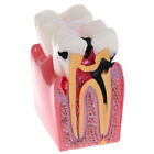 Dental Teeth Model 6 Times Caries Comparation Study Denture Tooth MoU ZR -w
