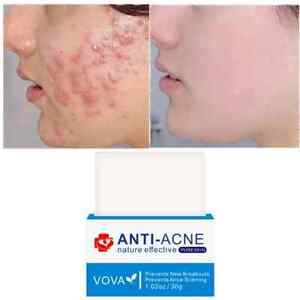 VOVA Anti-Acne Nature Effective Pure Skin - Acne Soap Bar for Breakouts Scarring