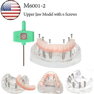 US M6001-2 Dental Implant All-on-6 Upper Jaw Restoration Model with 6 Screws - Picture 1 of 12