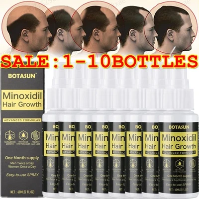 BOTASUN Extra Strength for Men Hair Regrowth Treatment Topical Solution 10 Months Supply