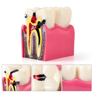 Modelo de diente dental 6 veces caries comparación bilateral herramientas patológicas - Imagen 1 de 19