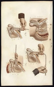 Cabinet de curiosité planche affiche A3 anatomie humaine chirurgie n°5 homme - Imagen 1 de 1