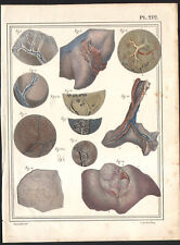 1825 Lithographie aquarellée Vaisseaux artères poumons broncheAnatomie Chirurgie