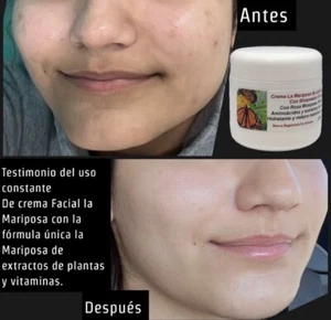 Crema 100% Natural facial De Kojic acid, Sin Químicos, Con Fórmula mariposa. - Picture 1 of 7