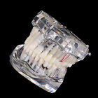 New Dental Implant Disease Study Pathological Teeth Model Analysis Demonstration