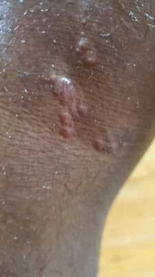 Eczema/Dermatits Treatment Spray Psoriasis/Treats Acne/Rosacea/Pet Rash 4 oz. - Image 1 of 3