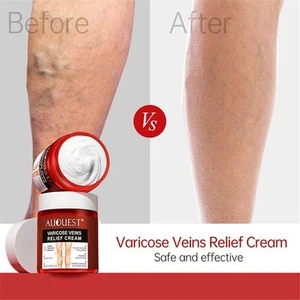 Crema de tratamiento para eliminación de venas varicosas anti arañas estrías vasculitis nueva⊹ - Imagen 1 de 9