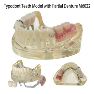 Dental Restoration Implant Typodont Teeth Model with Partial Denture M6022 - Picture 1 of 9