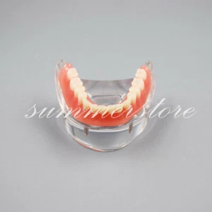 Dental Teaching Lower Overdenture 2 Implants Inferior Teeth Demo Model #6002 - Picture 1 of 6