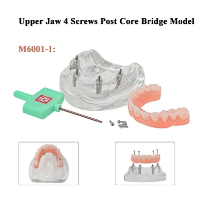 Tratamiento de implante dental todo en 4 EE. UU. Modelo de mandíbula superior 4 implante transparente Foto 1 de 4