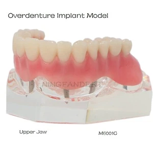 Overdenture Implant Model Upper Jaw Removable with 4 Screw Transparent - Picture 1 of 10