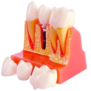 Modelo de implante dental con puente de corona extraíble - 4 veces agrandado...  - Imagen 1 de 6