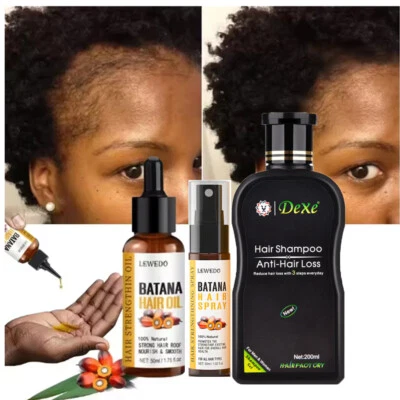 Hair Growth Oil Hair Regrowth Treatment Anti-Hair Loss Shampoo For Men & Women - Image 1 of 4