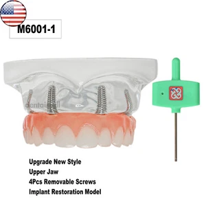 Implante Dental Mandíbula Superior Restauración Modelo 4 Tornillos con Poste Núcleo Puente 6001-1 - Imagen 1 de 11