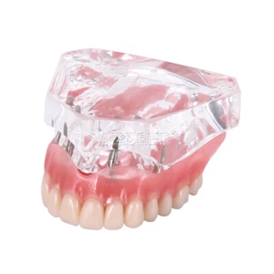 Dental Implant Upper Teeth Model Demo Overdenture Restoration with 4 Implants - Picture 1 of 6