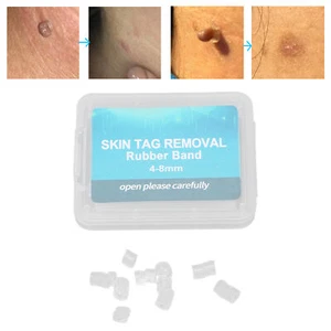 30 Stück Skin Tag Remover Gummiring Skin Tags Skin Tag Removal Kit Zubehör - Bild 1 von 14