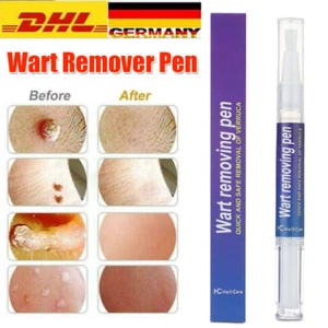 Wirksamer Warzenentferner Stift Skin Tag Mole Remover Beseitigt Hornhautwarzen - Bild 1 von 18