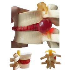 Carejoy 1:1.5 Medical Spine Lumbar Disc Herniation Demonstration Model Biology