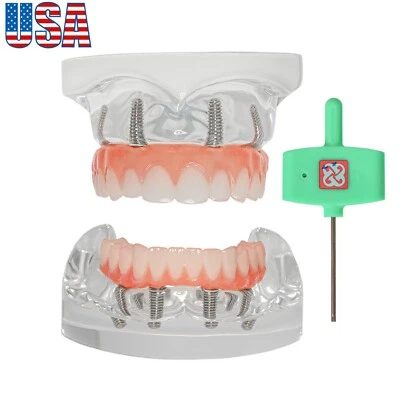 US Dental Implant Overdenture Model All-on-4 With 4 Screws Upper/Lower Clear Jaw - Image 1 of 4