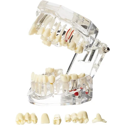 3D Teeth Model Dental Oral Typodont Model Ortho Implant Pathological Demo Model