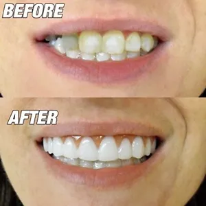 Instant Smile Comfort Fit Flex Teeth Top Cosmetic Veneer One Size Fits Most - Picture 1 of 4