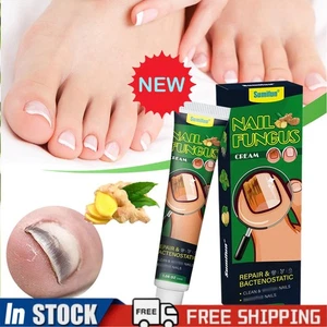 Neu Nagelpilz Creme Behandlung Onychomykose Finger Zehen Paronychie Salbe - Bild 1 von 12