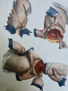 1850 Anatomy Surgery Amputation Of The Leg 1 Lithograph - Picture 1 of 3