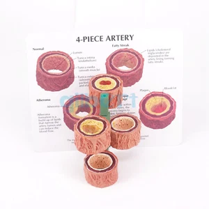 4-Stage Cross Section Human Artery Anatomical Vascular Occlusion Model Teaching - Picture 1 of 4