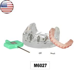 Implante dental de mandíbula inferior modelo de dientes de EE. UU. 4 tornillos con poste núcleo puentes restauración - Imagen 1 de 8