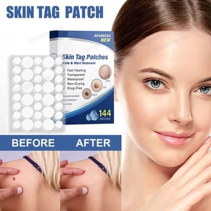 144stk Skin Tag Remover Patches Wart Removal Natür Inhaltsstoffe Sicher effektiv - Picture 1 of 16