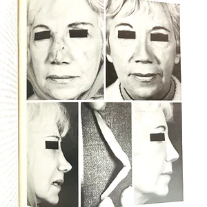 Vintage The Unfavorable Result in Plastic Surgery Avoidance Book Hardcover 1972 - Picture 1 of 15