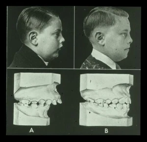 1920's Lantern Slide Showing Juvenil Boy With Before/After Dental Correction - Picture 1 of 3