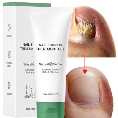 Gel de tratamiento de hongos en las uñas Nutraboost, hongos en las uñas, crema para hongos (1 pieza) Foto 1 de 4