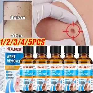 Wart Remover Flüssigkeit Plantar Genital Warzen behandeln Haut Tags Entfernung - Picture 1 of 23