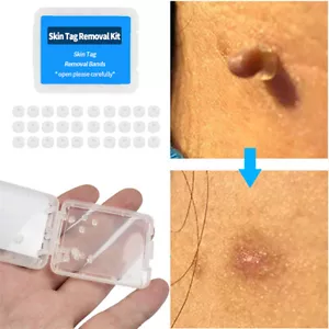 30 un. bandas de goma para eliminar etiquetas de la piel microbanda topo cuidado facial no tóxico - Imagen 1 de 12