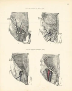 Anatomy. Inguinal & Femoral Hernia Topography 1880 old antique print picture - Picture 1 of 1