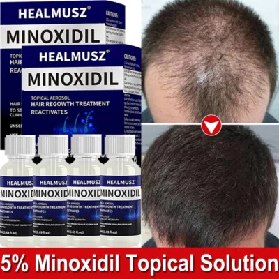 4PACK Minoxidil 5% Extra Strength For Men 4 Month Supply Hair Regrowth Solution - Image 1 of 4