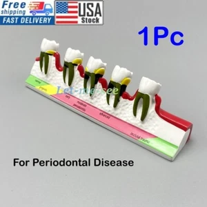 Dental Periodontal Disease Assort Teeth Dentoform Models Study Teaching Model - Picture 1 of 11