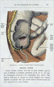 MÉDECINE : VOIES DIGESTIVES: COECUM, VALVULE de BAUHIN & APPENDICE - Gravure 19e - Picture 1 of 3