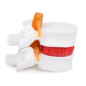 1PC Anatomical Human Lumbar Vertebrae Degenerative Enlargement Disease Model - Picture 1 of 9