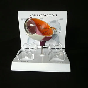 Anatomical Human Corneal Disease Model - Bild 1 von 4