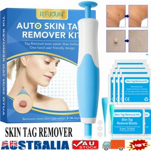 Natural Painless Auto SKIN TAG Removal Kit Skin Tag Micro Bands Remover Device - Picture 1 of 15