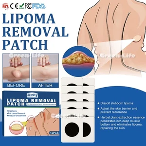 Patch rimozione lipoma a base di erbe lipolisi organica sollievo noduli grassi - Imagen 1 de 12